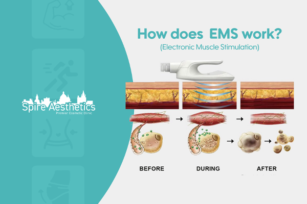 EMS treatment for post pregnancy weight loss treatment Weston Super Mare