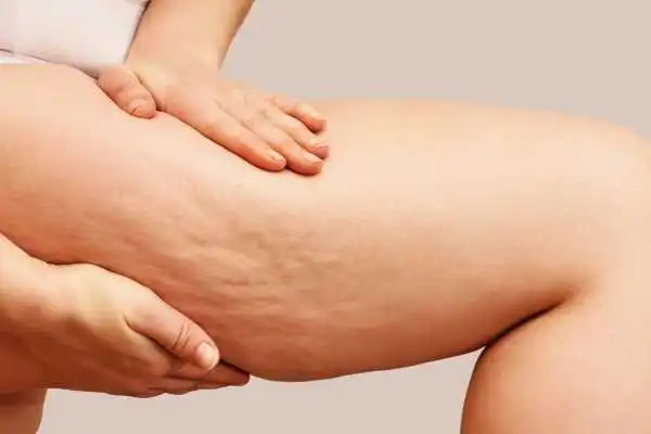 Image of woman showing leg with cellulite Weston Super Mare