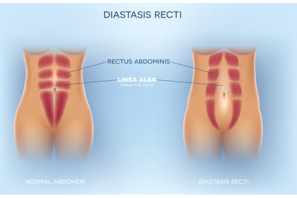 What Non-Surgical Options Are Available for Diastasis Recti Weston Super Mare?