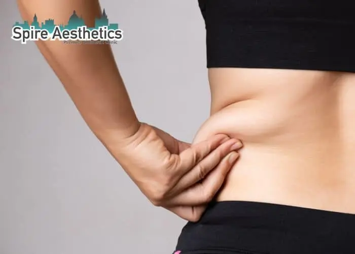 Image of woman pinching fat on their hips Weston Super Mare. Fat Freezing treatment