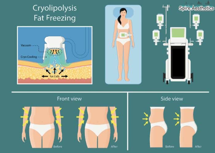 Image of diet and fat freezing combined for best results for Spire Aesthetics Weston Super Mare
