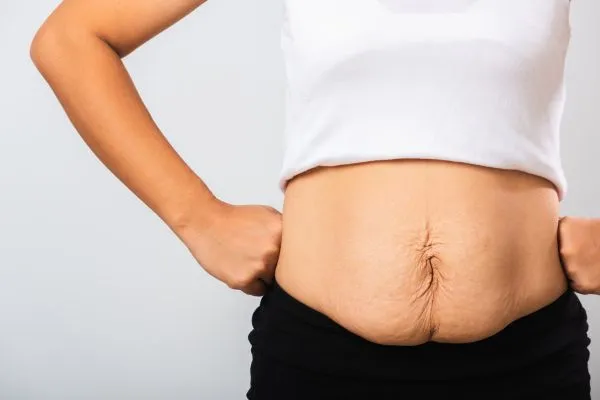 Image of a woman's stomach after weight loss with sagging skin following a gastric band Weston Super Mare