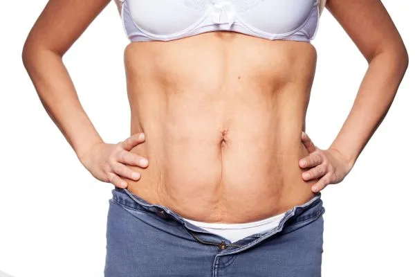 sagging skin on woman's stomach after weight loss injections Weston Super Mare
