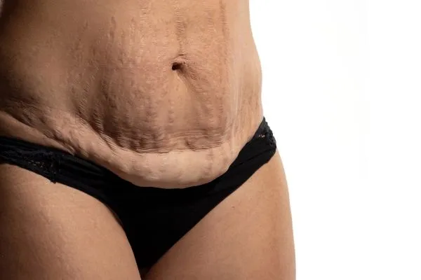 Image of womans stomach after weight loss injections Weston Super Mare showing saggy skin