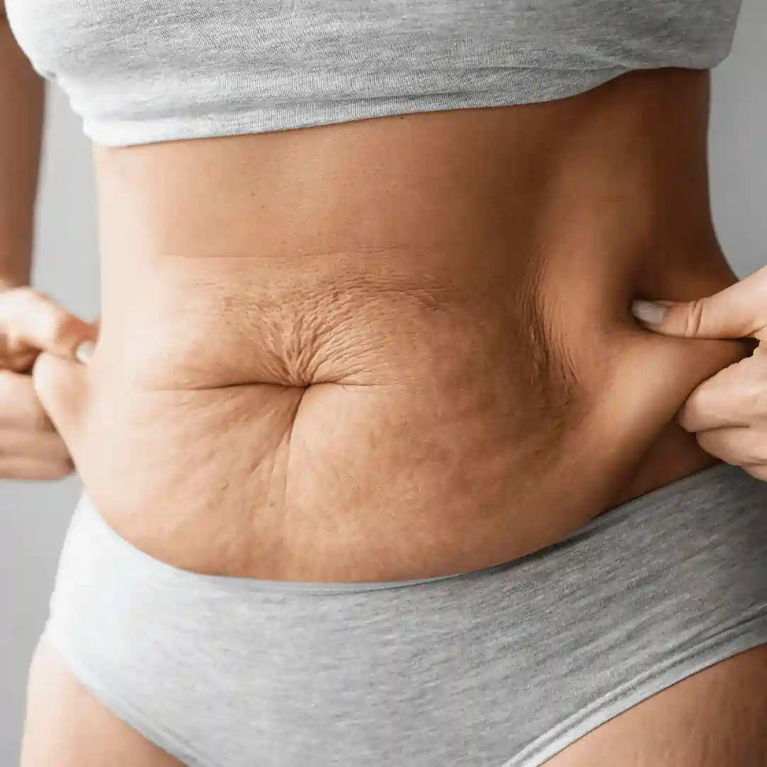 Is It Normal to Have Loose Skin After Pregnancy Weston Super Mare?