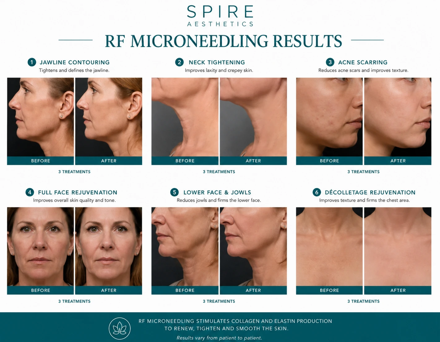 RF Microneedling Skin tightening Weston Super Mare results