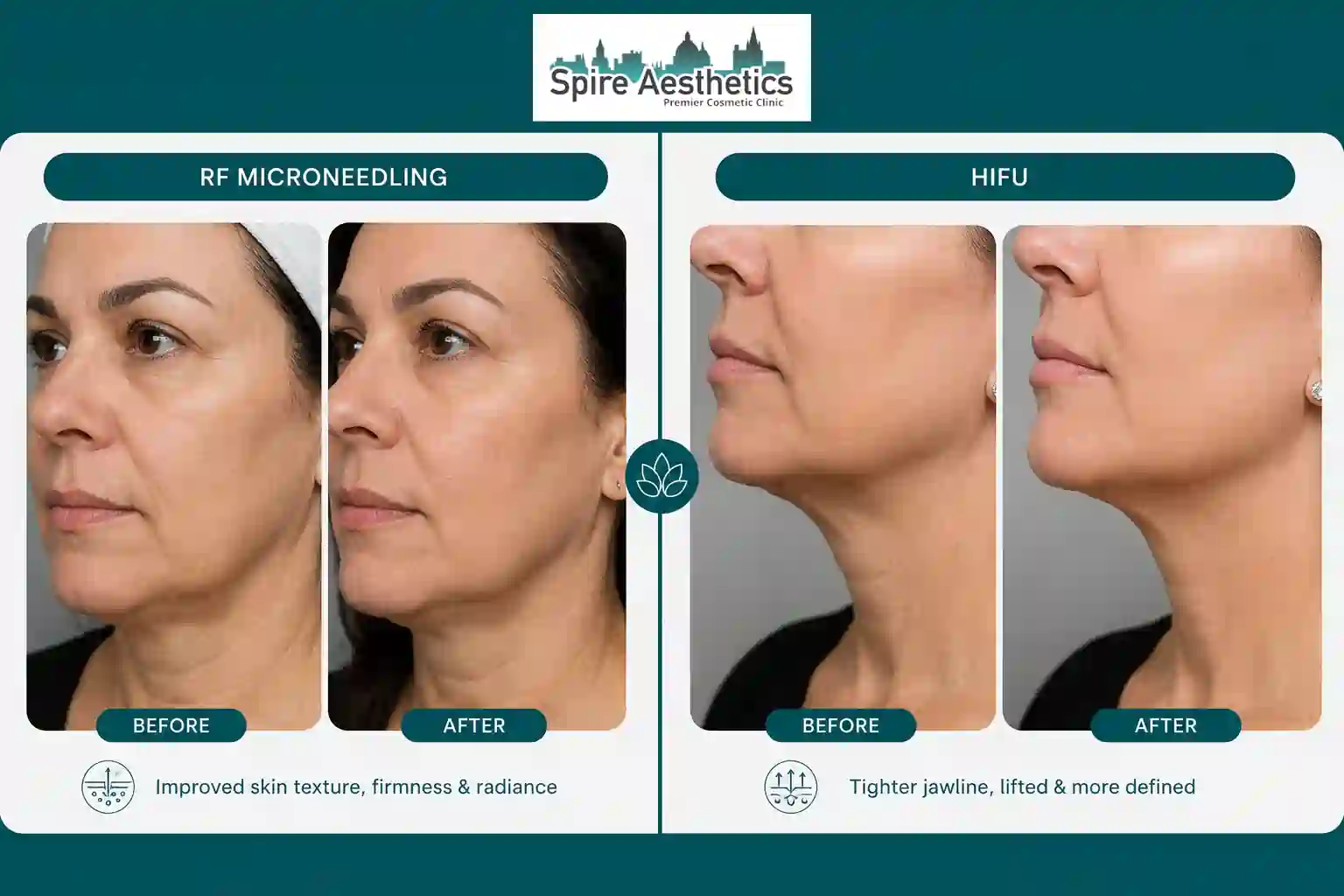 Can RF Microneedling and HIFU Be Combined Weston Super Mare?