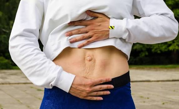 When Could Diastasis Recti Be the Missing Piece of the Puzzle Weston Super Mare?