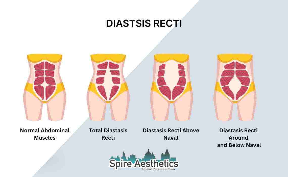 Is Non-Surgical Diastasis Recti Treatment Right for You? Common Concerns Answered Weston Super Mare